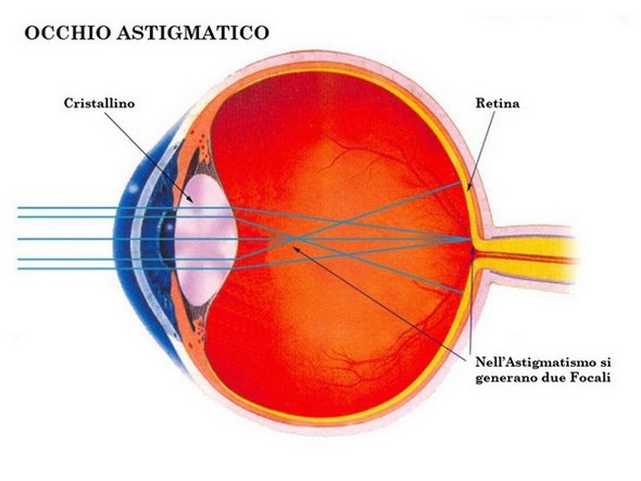 l'immagine raffigura un occhio astigmatico
